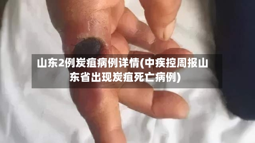 山东2例炭疽病例详情(中疾控周报山东省出现炭疽死亡病例)