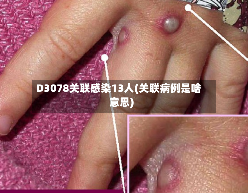 D3078关联感染13人(关联病例是啥意思)